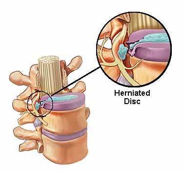Disc Injuries – Thoracic Disc Herniation and Chiropractors