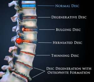 Lumbar-problems