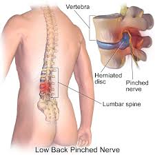 Lumbar Back Pain and Chiropractic Treatment